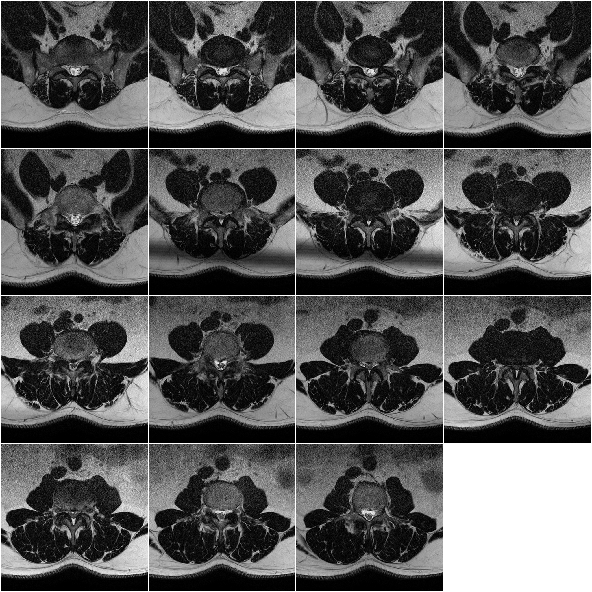 Axial Composite MRI overview of lumbar disc spaces