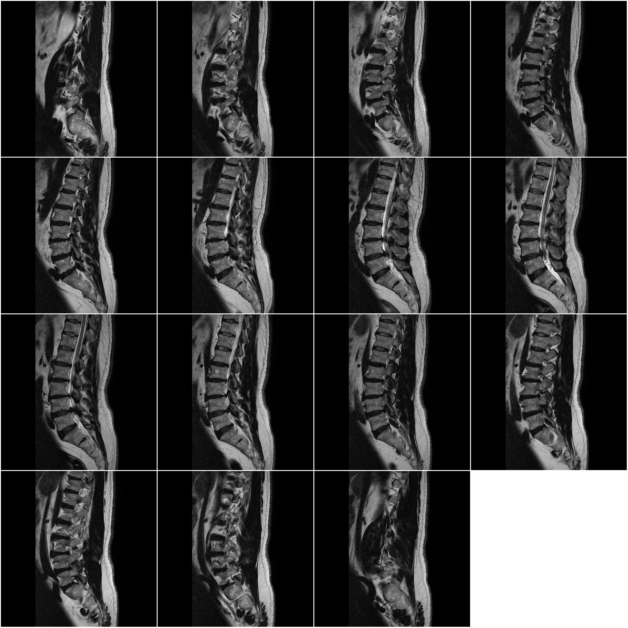 Sagittal Composite MRI overview of lumbar spine series